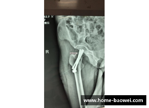 体育明星股骨骨折案例解析与康复全过程详解
